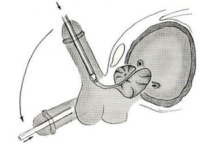 Endoszkópos péniszbővítési műtét sémája