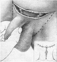 A pénisz műtéti meghosszabbítása rejtett részének kihúzásával