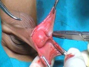 Férfi pénisznövelő műtét